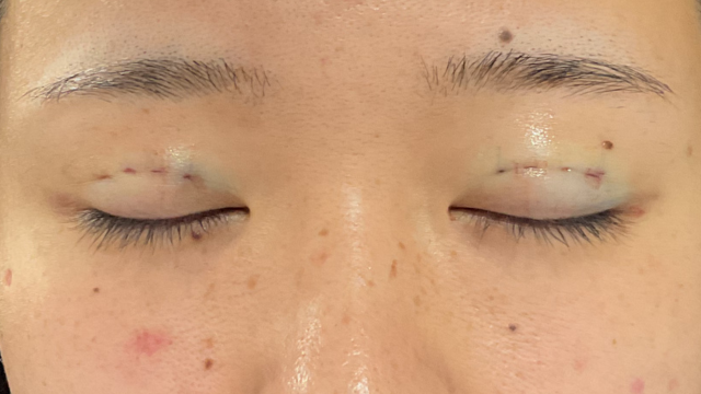 手术前的状态 其一