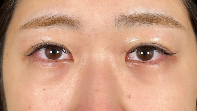 手术前的状态 其一