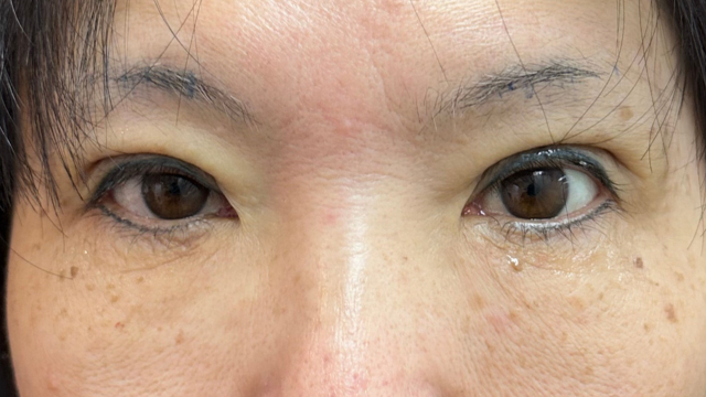 手術前の状態 その1