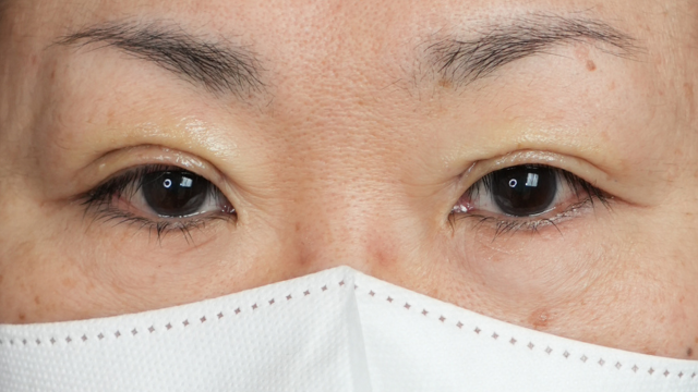 手術前の状態 その1