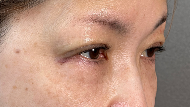 手術前の状態 その1