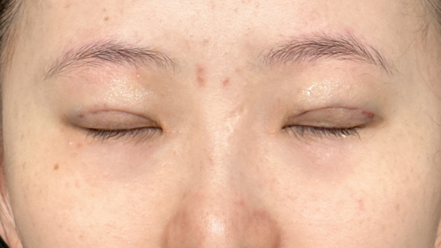 Postoperative Condition Part 1