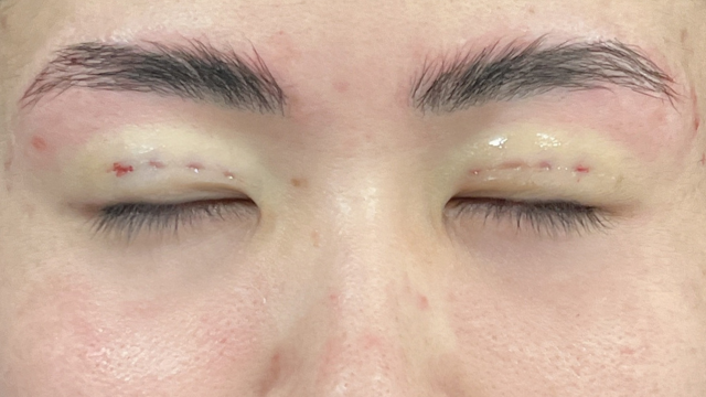 手術前の状態 その1