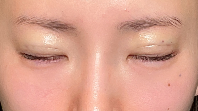 手术前的状态 其一