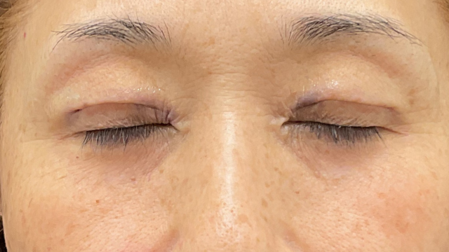 手术前的状态 其一