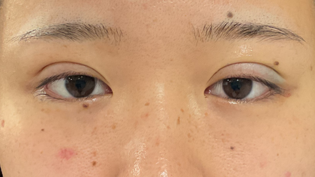 手术前的状态 其一