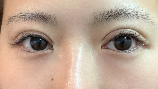 手術前の状態 その1