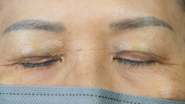 手术前的状态 其一