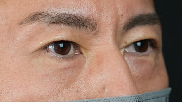 手术前的状态 其一