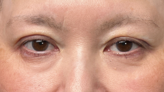 手术前的状态 其一