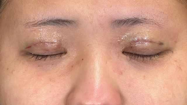 手术前的状态 其一