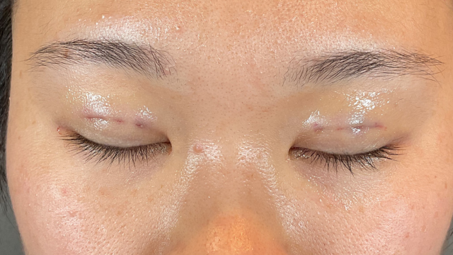 手术前的状态 其一