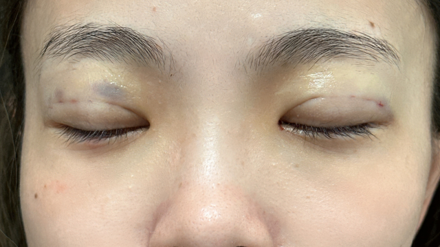 手术前的状态 其一