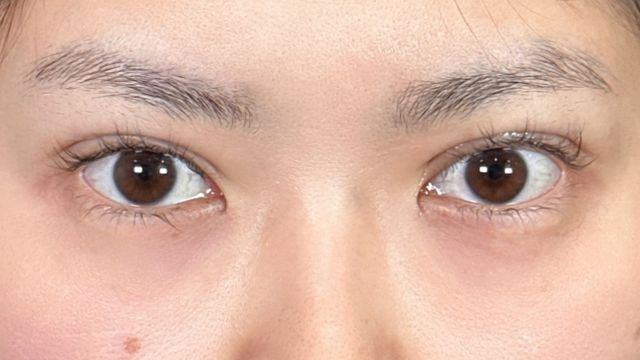 手术前的状态 其一