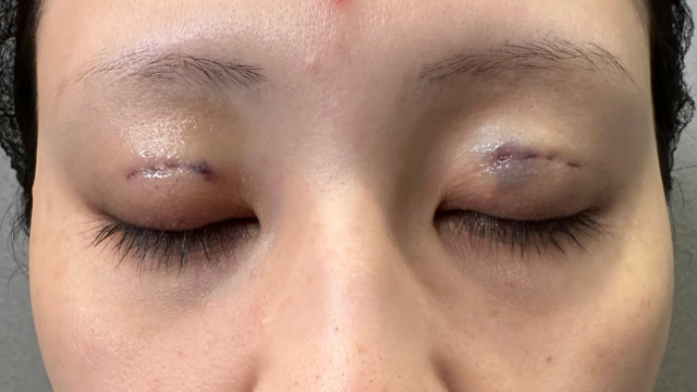 手术前的状态 其一