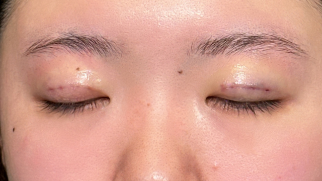 手术前的状态 其一