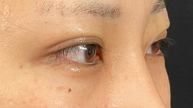 手術前の状態 その1