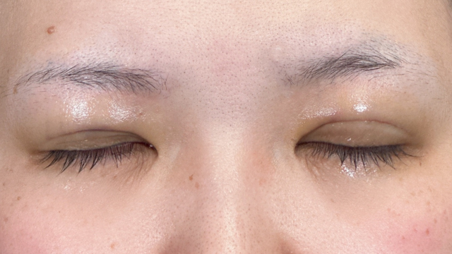 Postoperative Condition Part 1