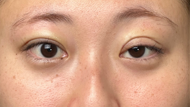 手術前の状態 その1