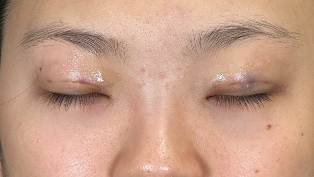 手術前の状態 その1