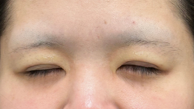 手術前の状態 その1