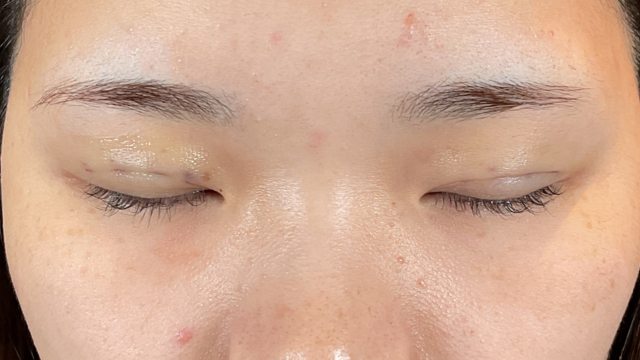 手術前の状態 その1