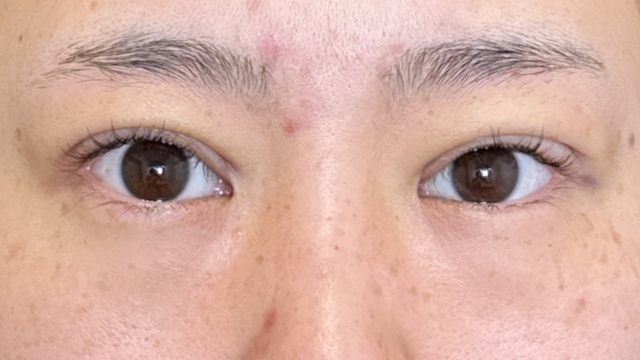 手术前的状态 其一