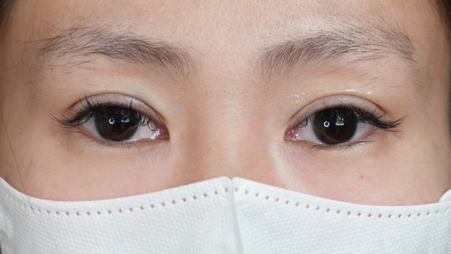 手術前の状態 その1