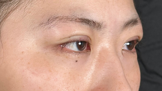 手术前的状态 其一