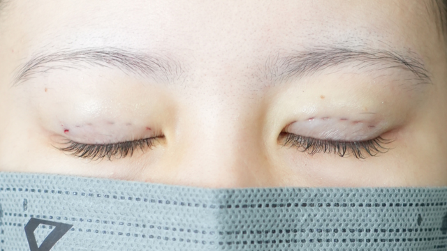 手術前の状態 その1