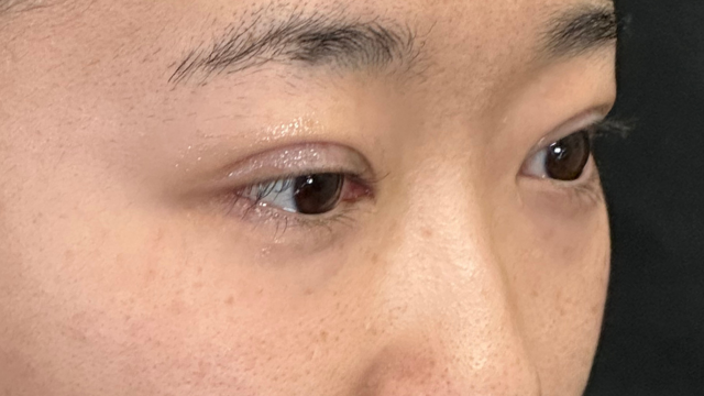 Postoperative Condition Part 1