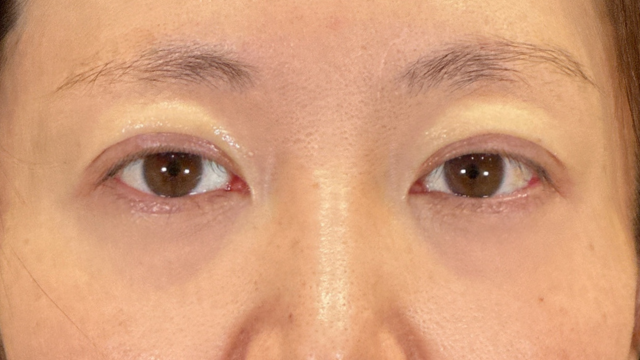 手術前の状態 その1