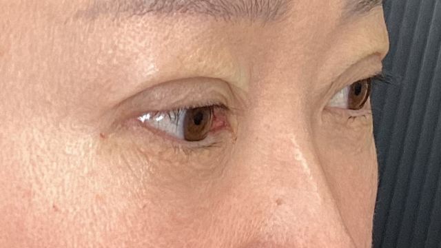 手術前の状態 その1