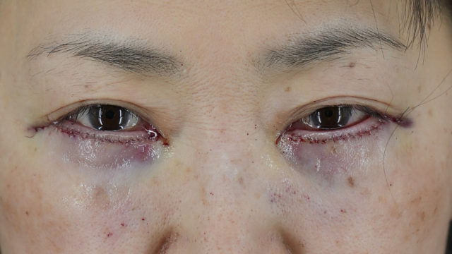 Postoperative Condition Part 1