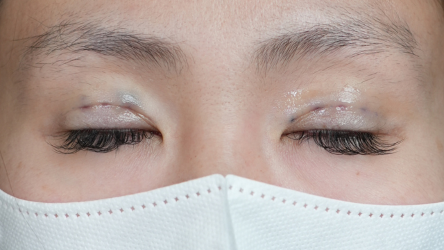 手術前の状態 その1