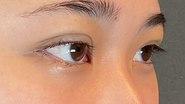 手術前の状態 その1