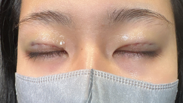 手术前的状态 其一