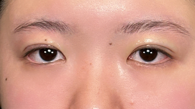 手术前的状态 其一