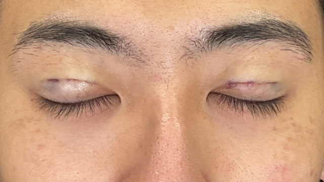 手术前的状态 其一