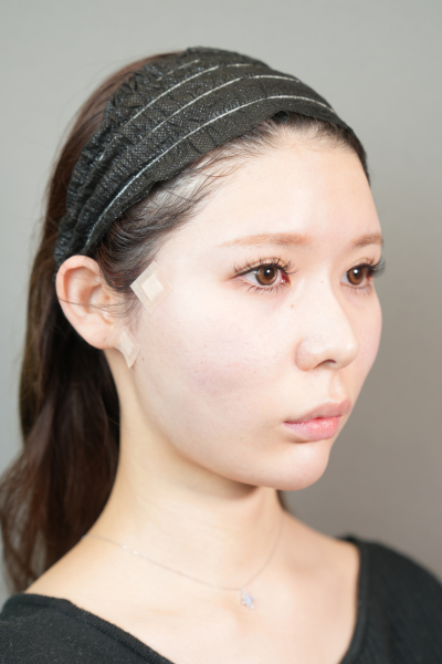 手術前の状態 その1