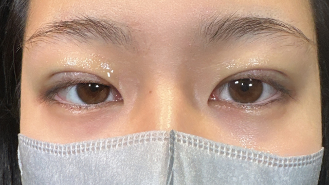 手术前的状态 其一