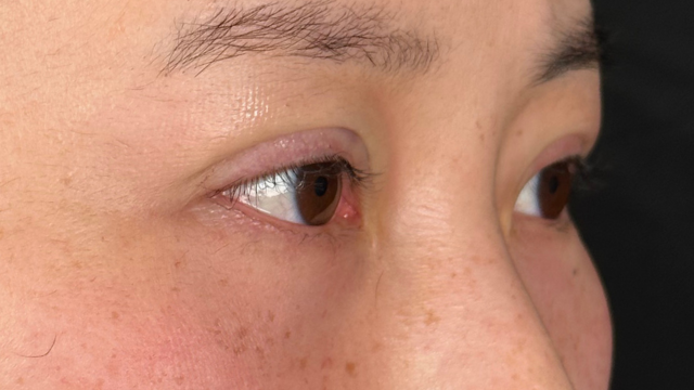 手术前的状态 其一