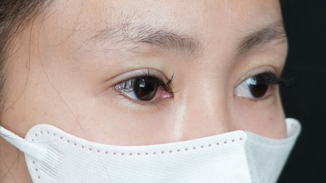 手術前の状態 その1