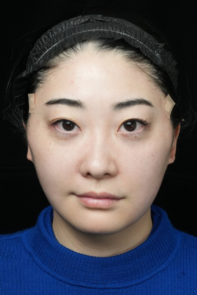 手术前的状态 其一