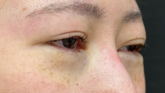 手术前的状态 其一