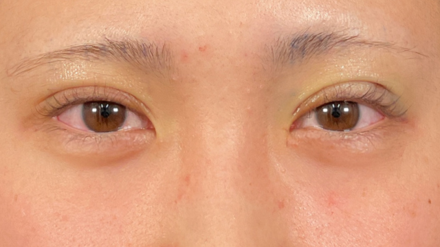 手术前的状态 其一