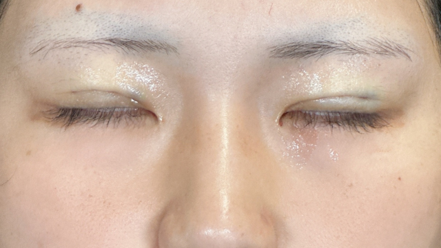 手術前の状態 その1