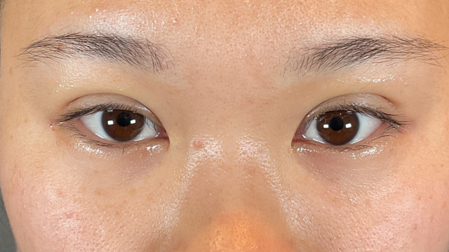 手术前的状态 其一