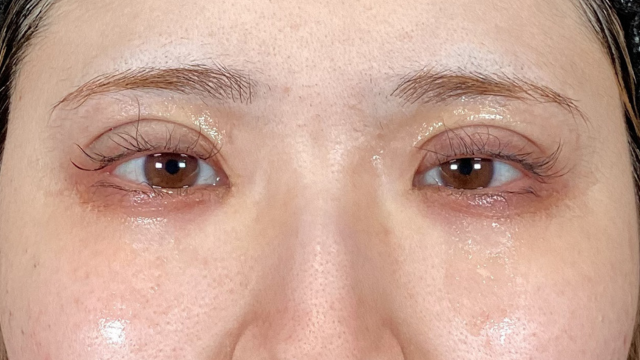 手術前の状態 その1