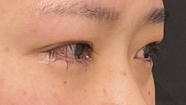 手术前的状态 其一